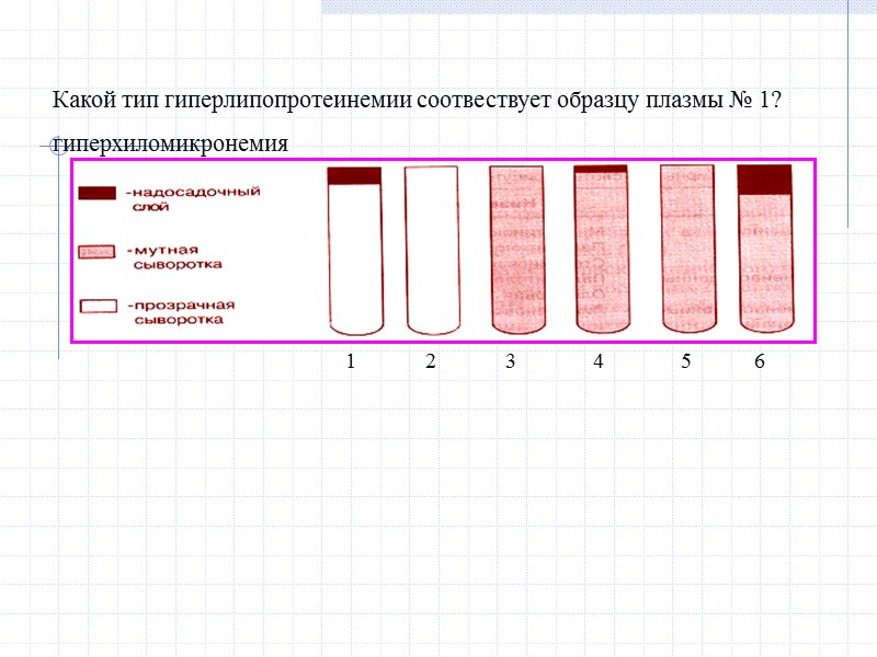 Какой тип гиперлипопротеинемии соотвествует образцу плазмы № 1? гиперхиломикронемия  1 3 5 4